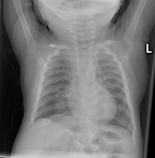 X-ray of infant chest. More description below