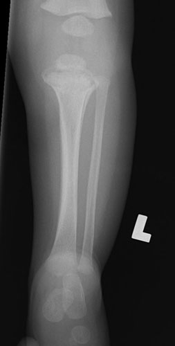 X-ray of lower leg. Description below