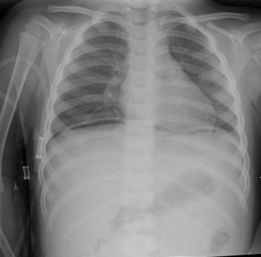 Chest X-Ray, further description below