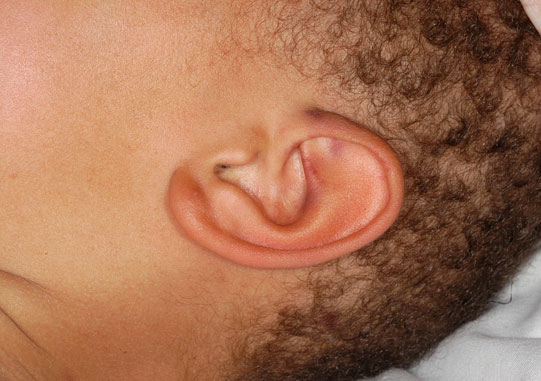 Picture of child's ear. Full description below