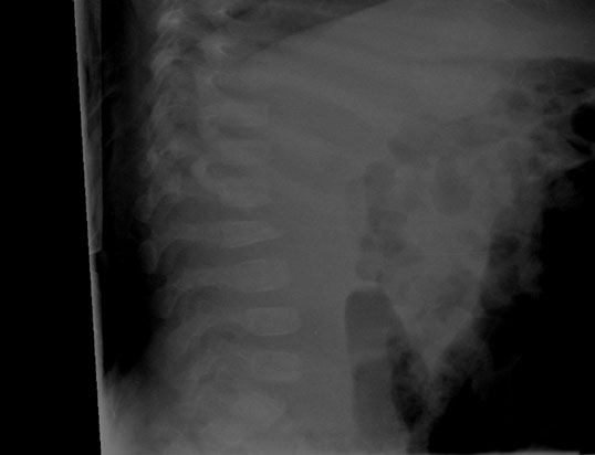 X-ray of lateral spine, detailed description below