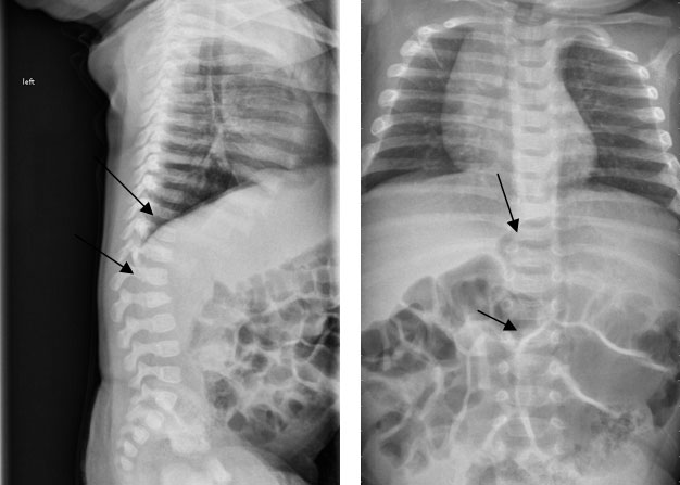 side by side x-rays, description below