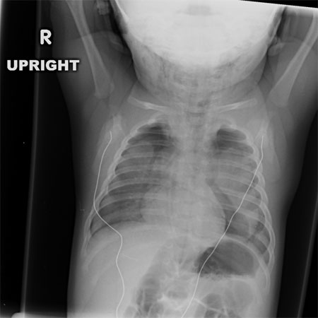 chest x-ray image right side