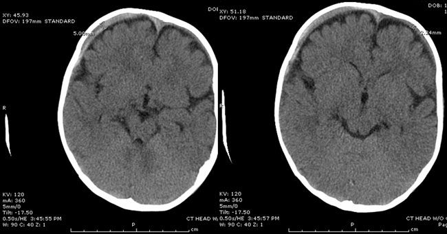 side by side images of brain scans, description below