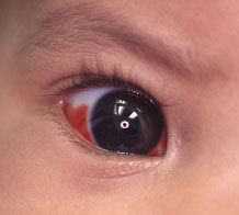 image of child's eye, description below